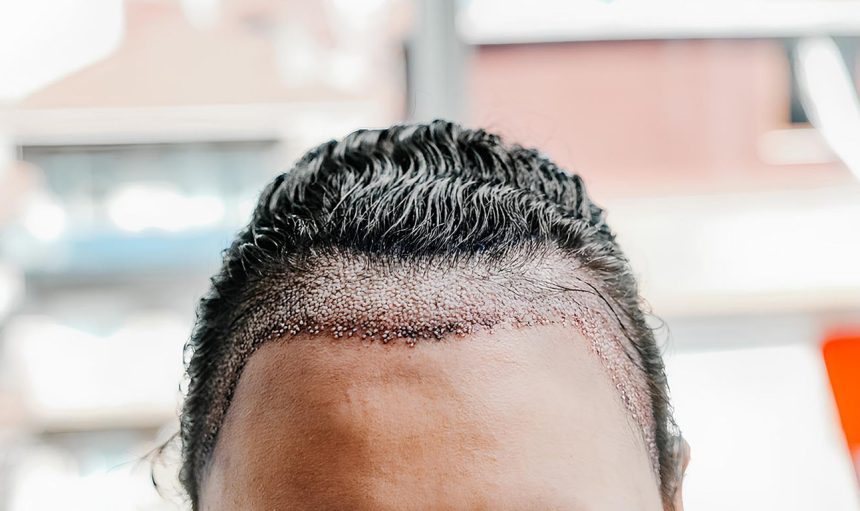 Unshaven-hair-transplant