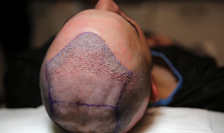 dhi-hair-transplant