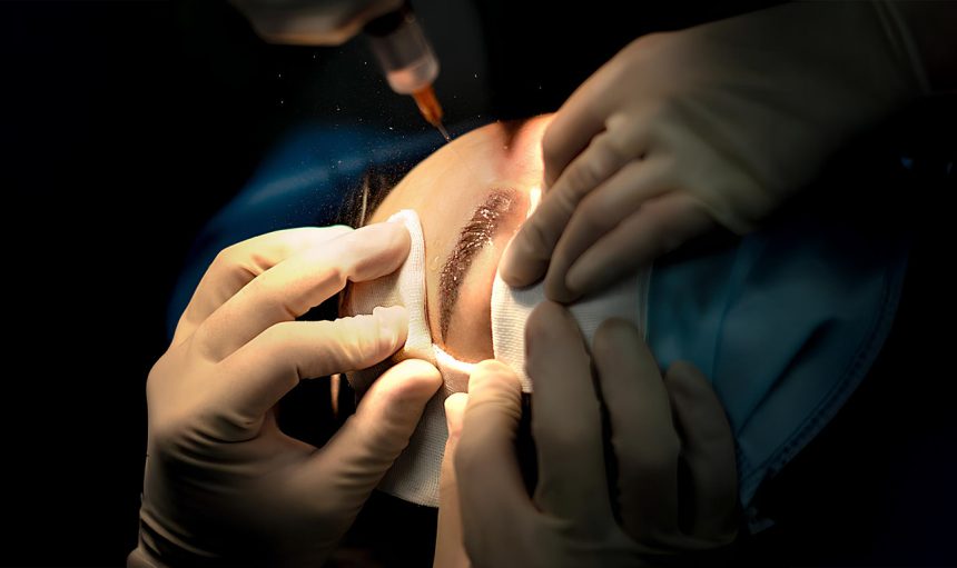 eyebrow-transplant