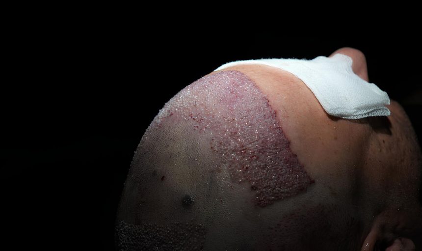 fue-hair-transplant
