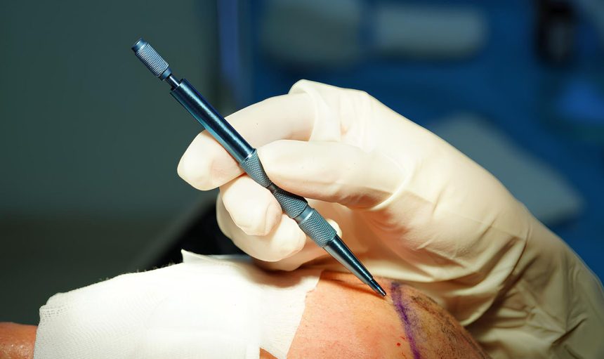 sapphire-fue-hair-transplant