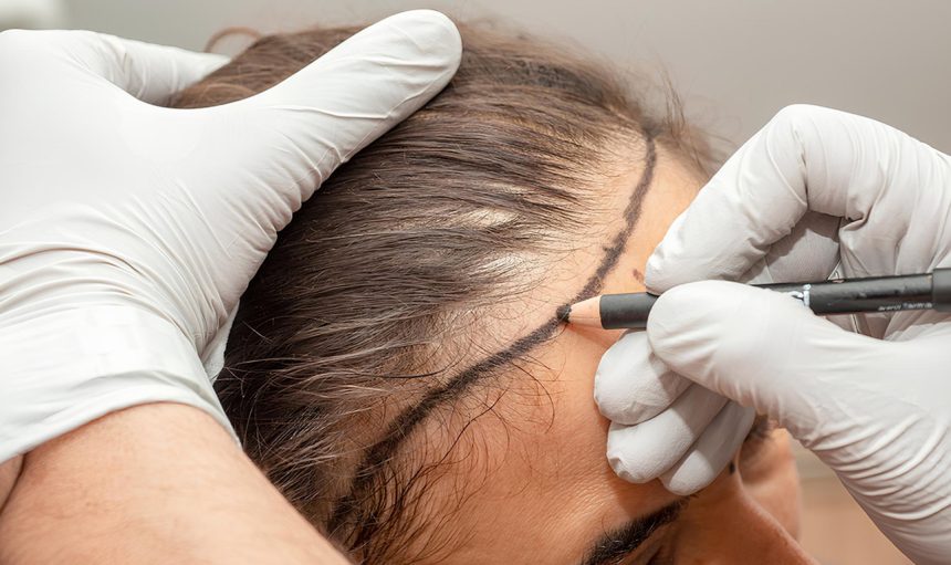 women-hair-transplant