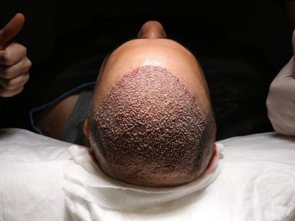 Türkiye'de Güvenilir Saç Ekimi