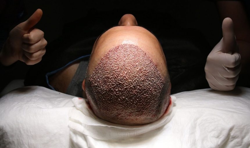 Türkiye'de Güvenilir Saç Ekimi