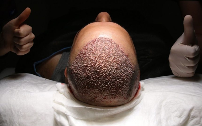 Türkiye'de Güvenilir Saç Ekimi